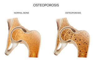 Home Care Fort Mill SC - How Might Your Loved One's Doctor Diagnose Osteoporosis?